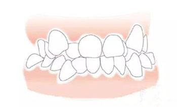 深度解析，牙齿错位是否需要拔牙？