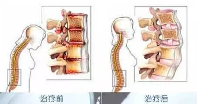 强直性脊柱炎患者能否报考公务员岗位？探讨疾病与职业选择的问题